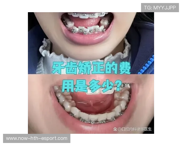 牙套与表现：咬合力影响爆发力？，牙套咬合是什么